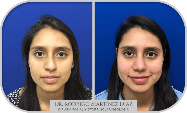 img_rinoplastia_U1