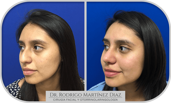 img_rinoplastia_U2