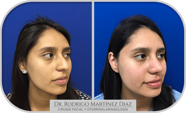 img_rinoplastia_U3
