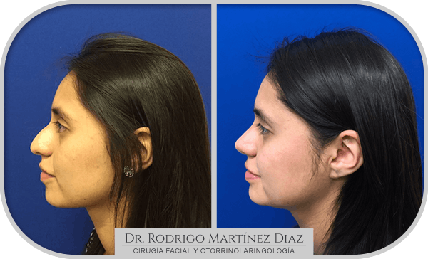 img_rinoplastia_U4