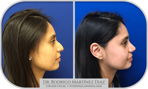 img_rinoplastia_U5