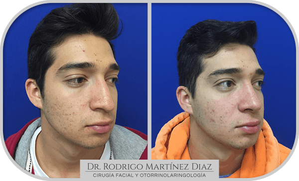 img_rinoplastia_U3