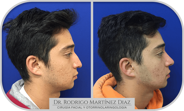 img_rinoplastia_U5