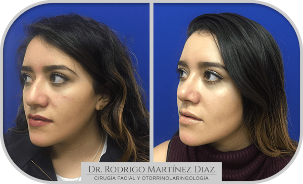 img_rinoplastia_V2