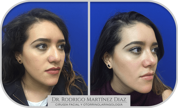 img_rinoplastia_V3