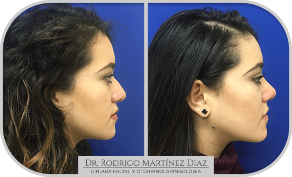 img_rinoplastia_V3