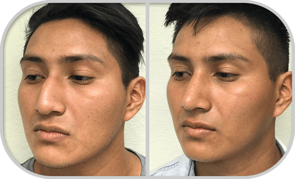 img_rinoplastia_U3
