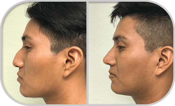 img_rinoplastia_U5