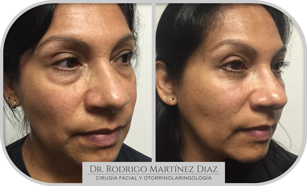 img_blaferoplastia_A4