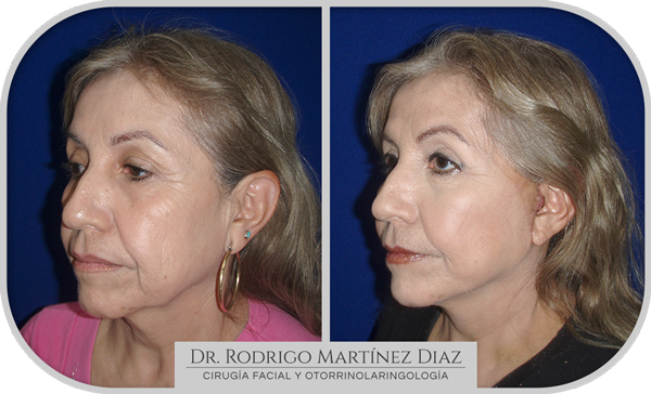 img_estiramiento_B3