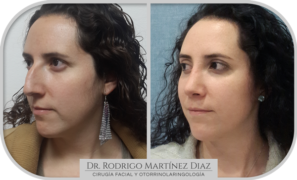 img_rinoplastia_K1