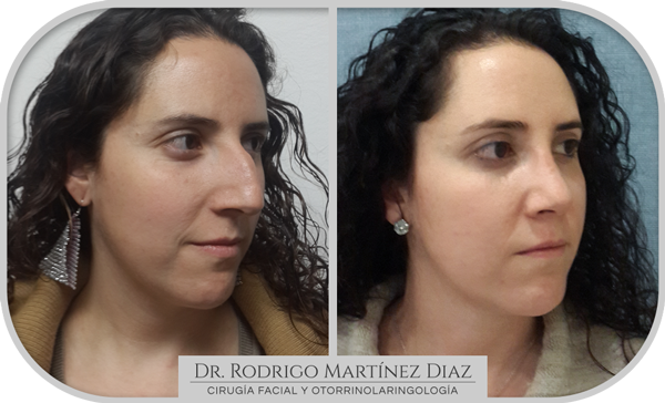 img_rinoplastia_K2