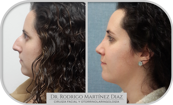 img_rinoplastia_K3
