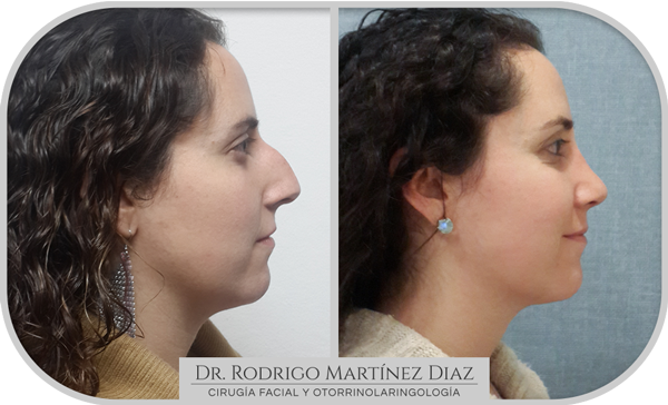img_rinoplastia_K4