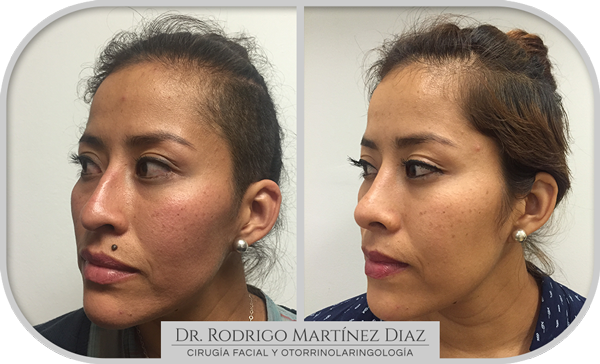 img_rinoplastia_E2