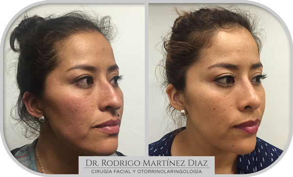 img_rinoplastia_E3