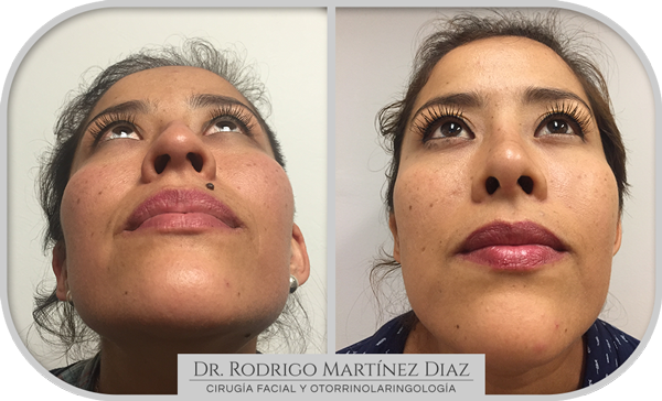 img_rinoplastia_E4