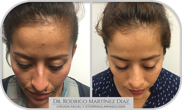 img_rinoplastia_E5