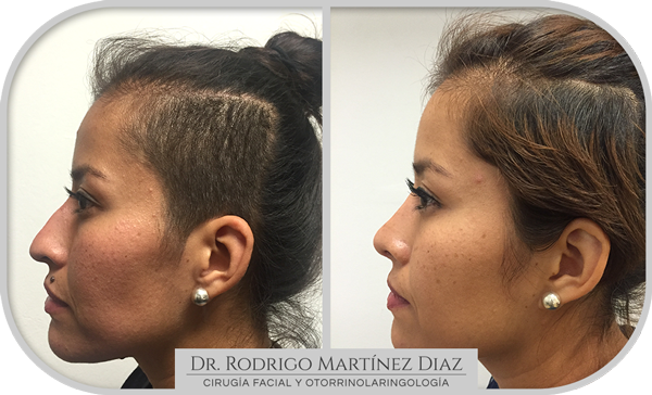 img_rinoplastia_E5