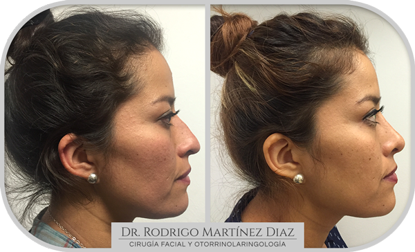 img_rinoplastia_E5