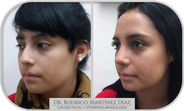 img_rinoplastia_L1