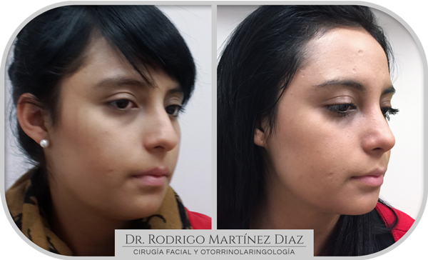 img_rinoplastia_L2