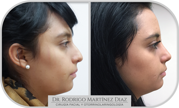 img_rinoplastia_L3