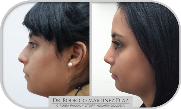 img_rinoplastia_L4