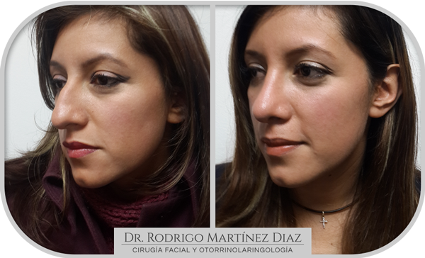 img_rinoplastia_M1