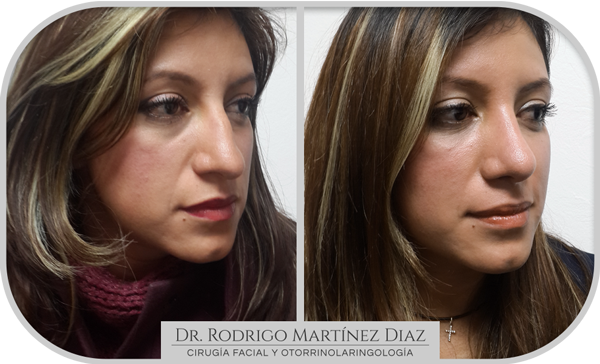 img_rinoplastia_M2