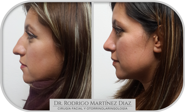 img_rinoplastia_M3