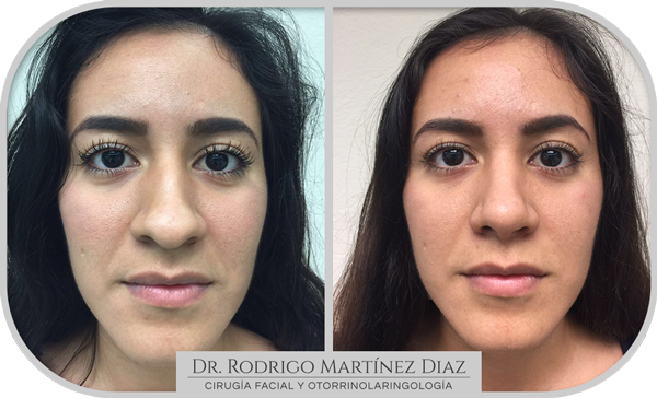 img_rinoplastia_F1