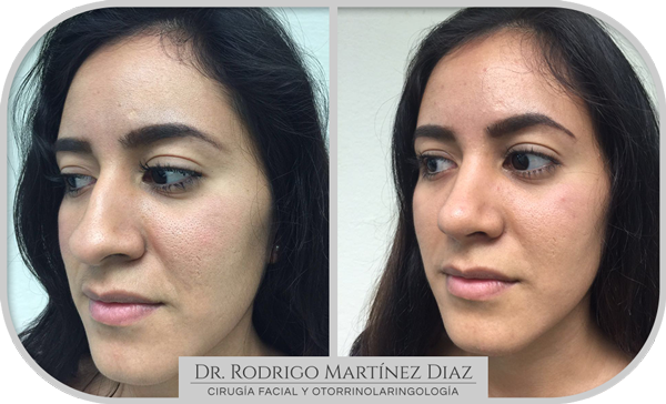 img_rinoplastia_F2