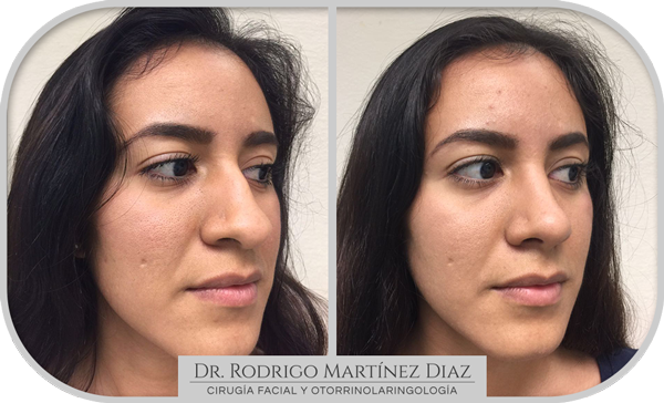 img_rinoplastia_F3