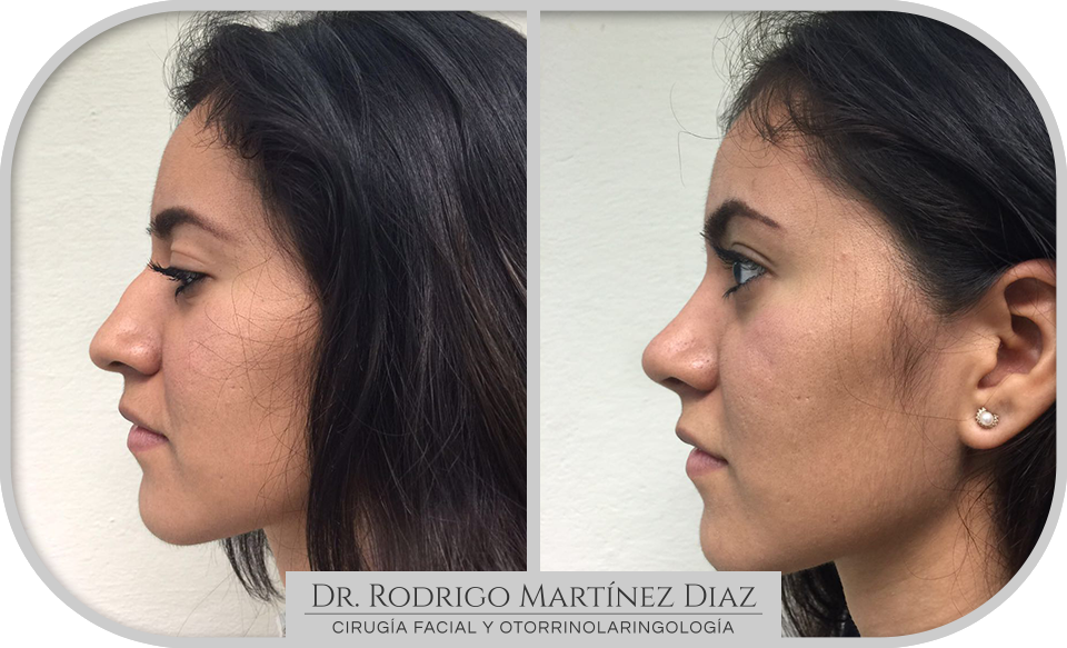img_rinoplastia_F4