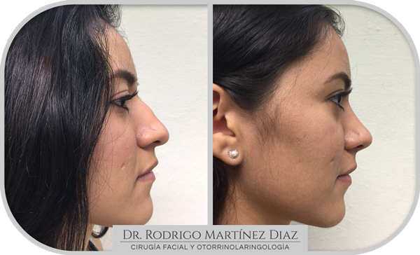 img_rinoplastia_F4