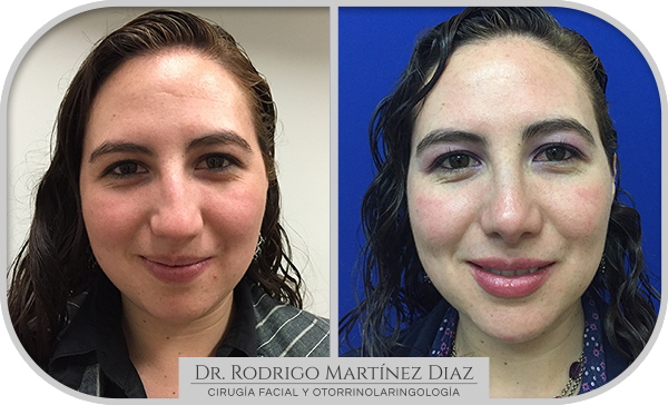 img_rinoplastia_A1