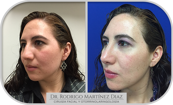 img_rinoplastia_A2