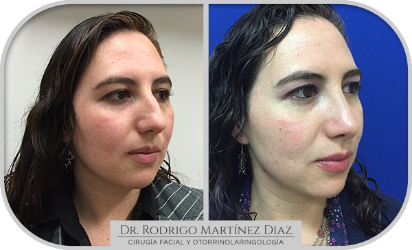 img_rinoplastia_A3