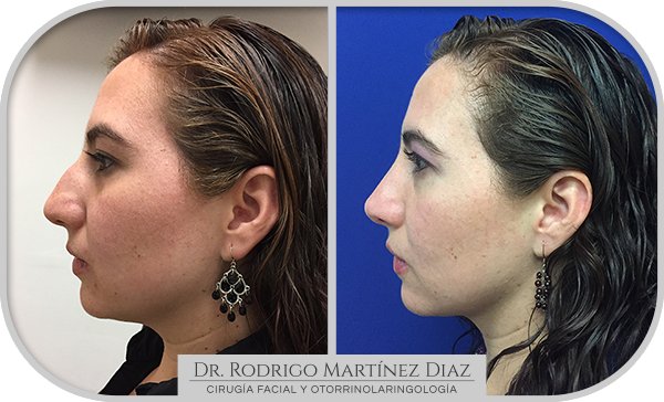 img_rinoplastia_A4