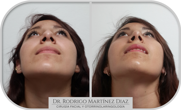 img_rinoplastia_N1