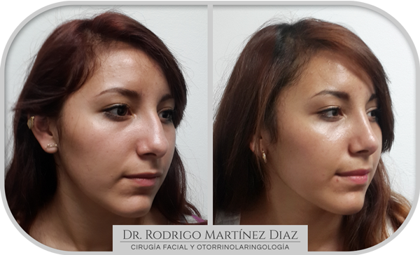 img_rinoplastia_N2