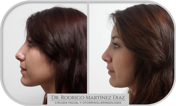 img_rinoplastia_N3