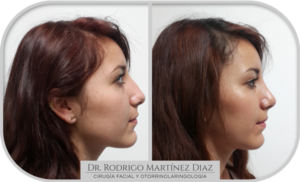 img_rinoplastia_N4