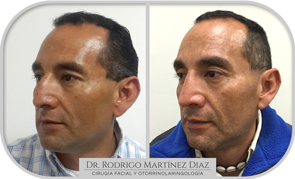 img_rinoplastia_O1
