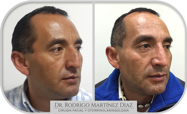 img_rinoplastia_O2