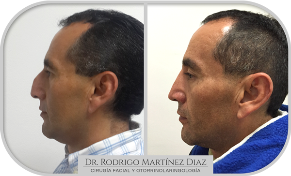 img_rinoplastia_O3