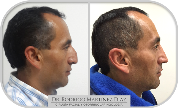 img_rinoplastia_O4