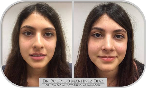 img_rinoplastia_G1