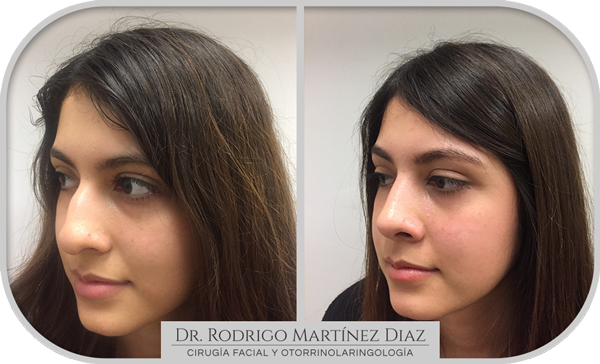 img_rinoplastia_G2